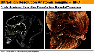 LAAO 23: Anatomy & Imaging - LAA anatomies