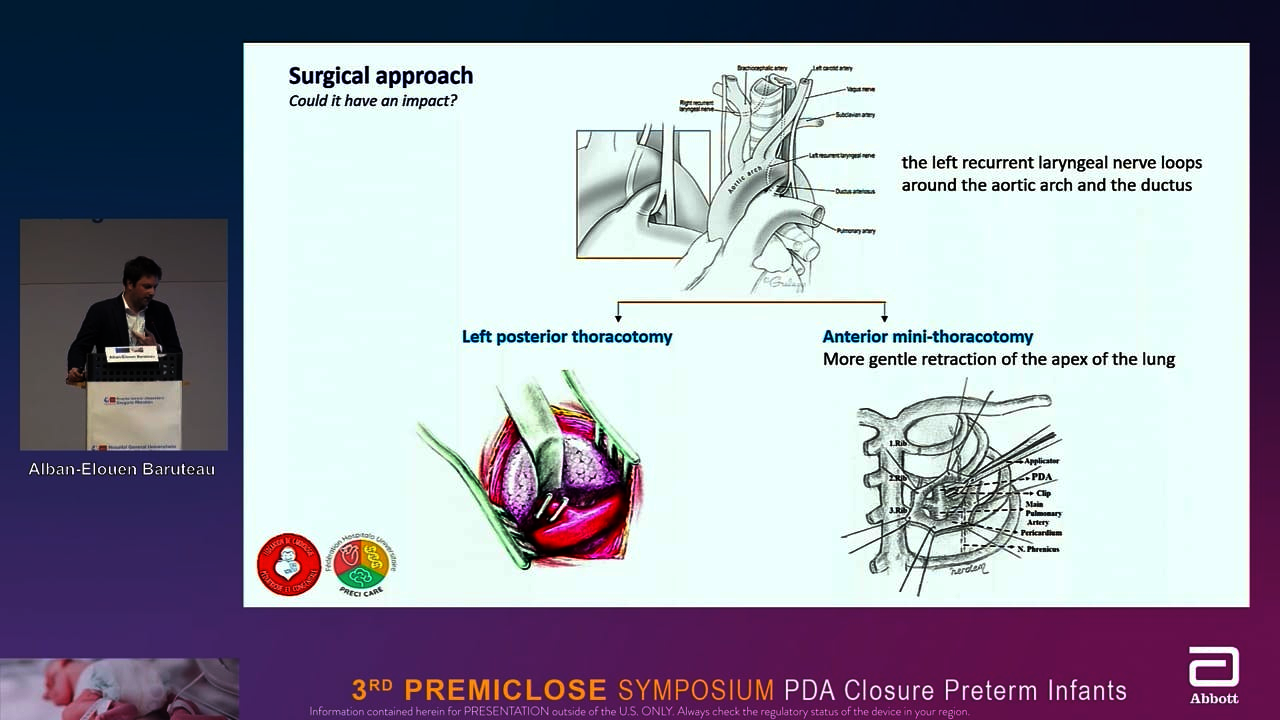 Premiclose 22: Transcatheter PDA closure