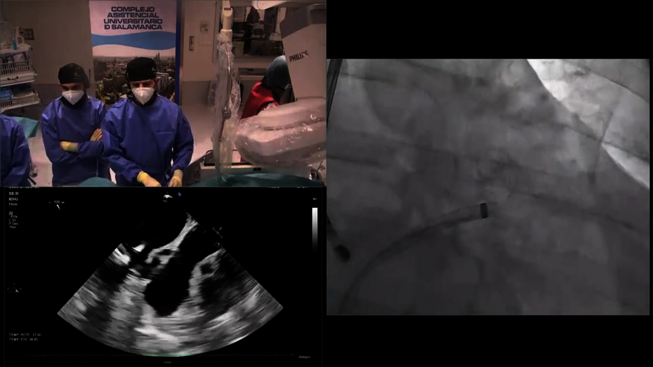 LAAO 23: Live case 1