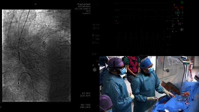 Treating Large annuli with 35mm Navitor Vision