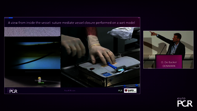 EuroPCR 2023: Vascular access