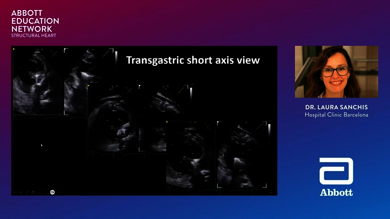 T-TEER: echo procedural approach
