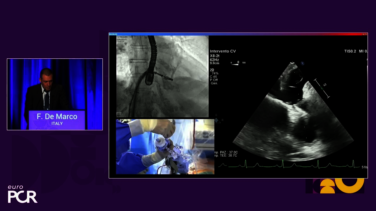 Enhancing clipping solutions for durable long-term patient outcomes - EuroPCR 2025
