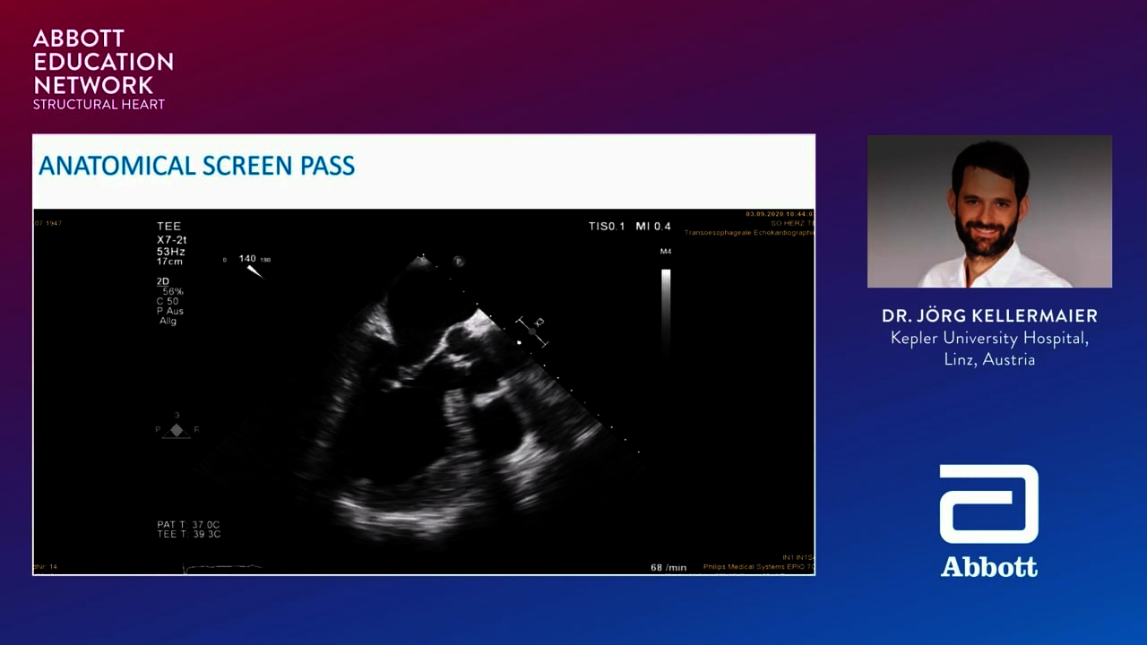 Transcatheter Mitral Valve implant