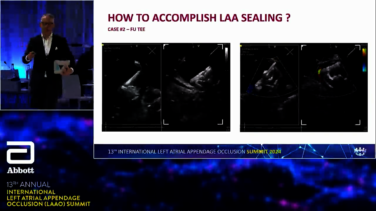 LAAO Summit - Sealing the appendage