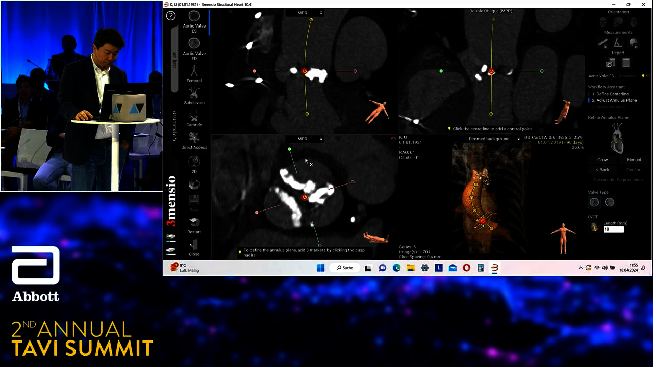 TAVI Summit - PreTAVR CT analysis